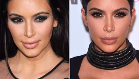 V-Line Surgery για μια λεπτή σιαγόνα