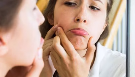 Πώς να χρησιμοποιήσετε το λάδι jojoba για ακμή