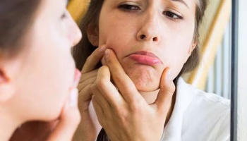 Πώς να χρησιμοποιήσετε το λάδι jojoba για ακμή